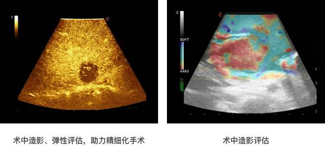术中造影、弹性评估.png